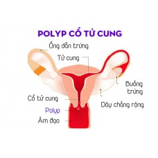 Biểu hiện Bệnh Polyp tử cung và cách điều trị hiệu quả