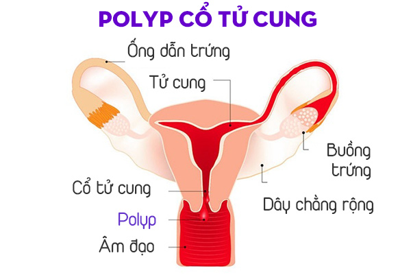 Bệnh Polyp cổ tử cung